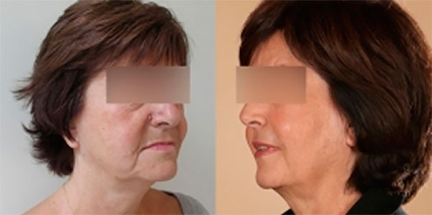 Est-ce qu'un dentier changer le visage ?