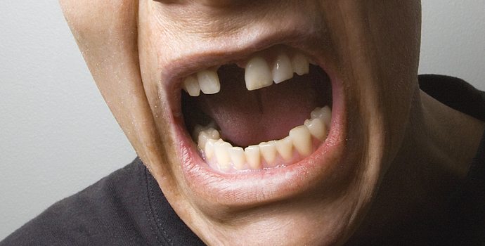 Comment Peut-on remplacer des dents manquantes ?