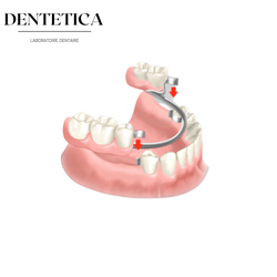 Prothèse dentaire provisoire, profitez d'une imitation de dents réaliste - Dent  Provisoire