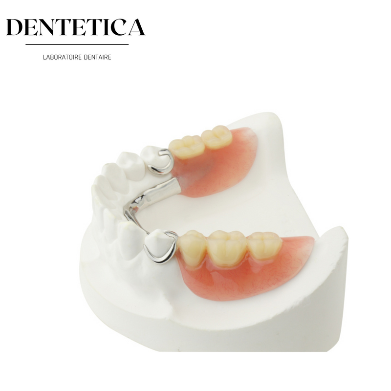 Différents Types de Prothèses Dentaires